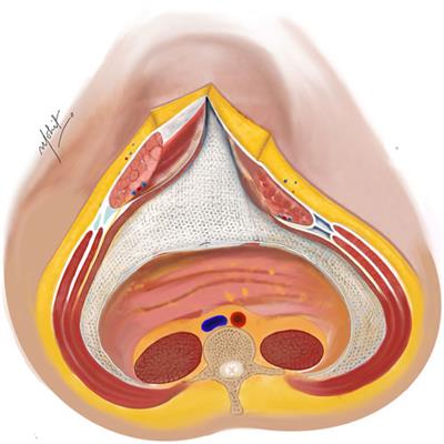 Posterior Component Separation Technique—Original Transversus Abdominis Release (TAR) Technique